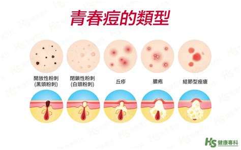 女生 痘痘|一直长痘痘怎么办？皮肤科医师告诉你有效治疗青春痘。